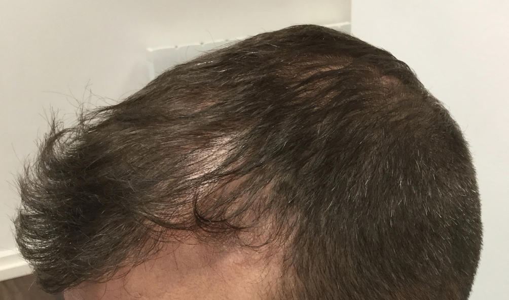 Hair Loss Before / After Treatment - PHP Aesthetic